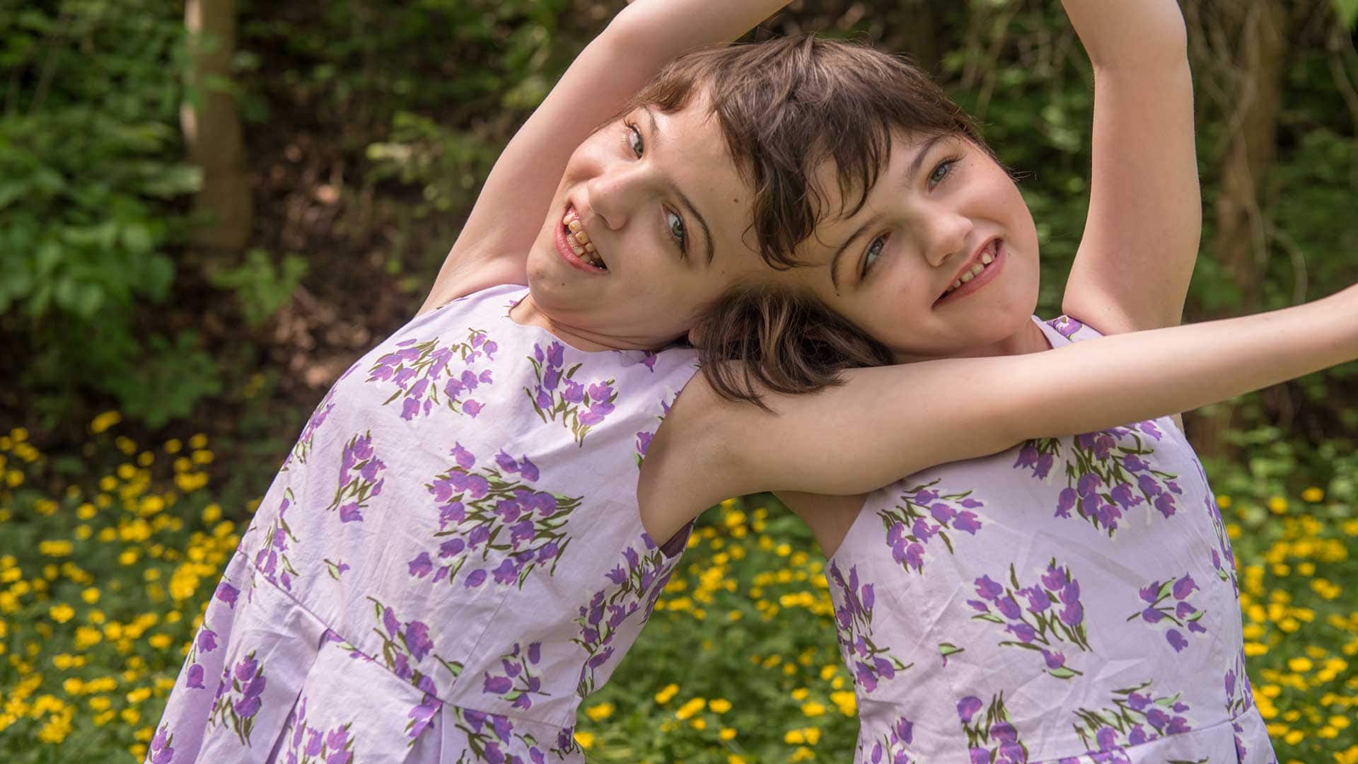 Conjoined Twins from British Columbia Can See Through Each Other’s Eyes and Hear Each Other’s Thoughts Because They Share The Same Brain.